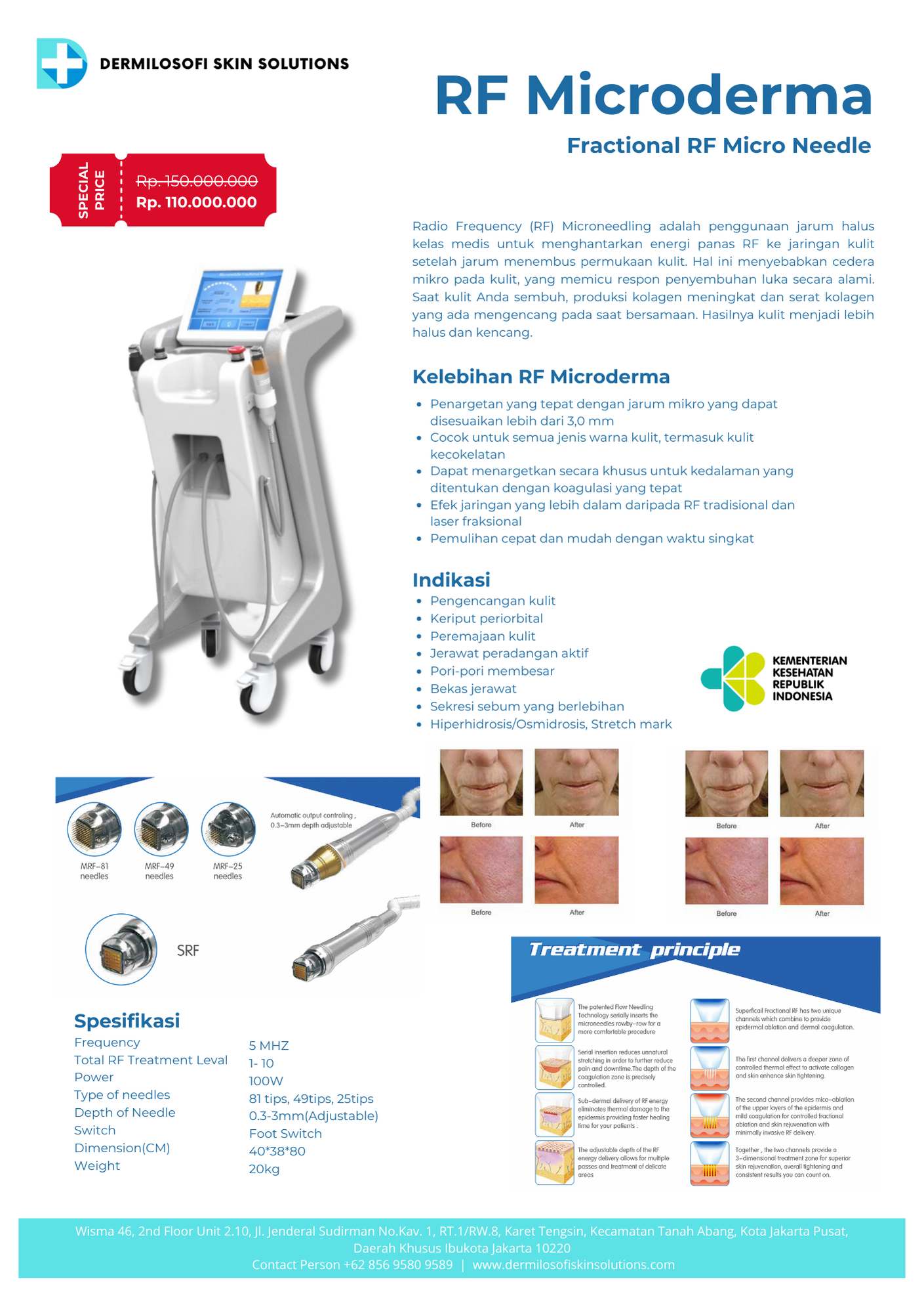 RF MICRODERMA